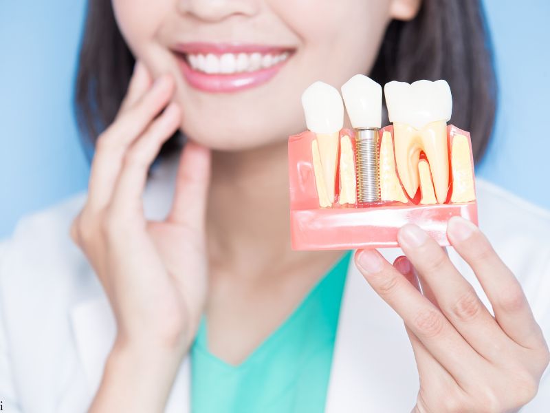 What Are Dental Implants?