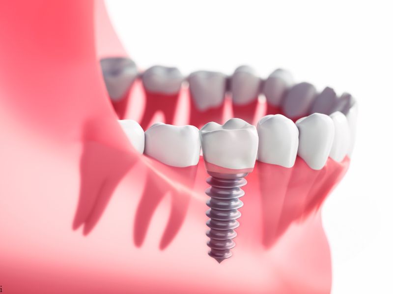 Are You a Candidate for Dental Implants?