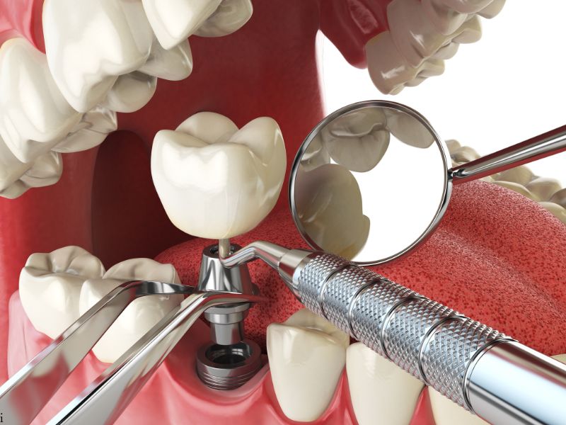 How to Handle Problems with Dental Implants
